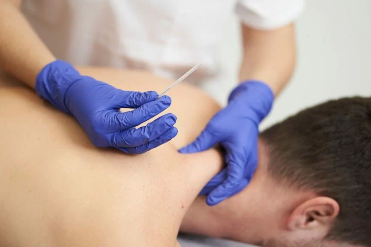 Dry Needling services
